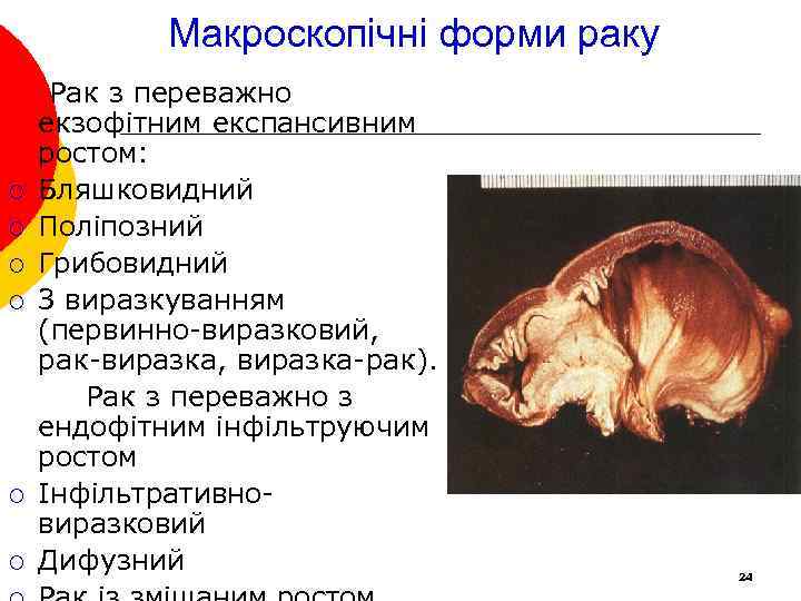 Макроскопічні форми раку ¡ ¡ ¡ Рак з переважно екзофітним експансивним ростом: Бляшковидний Поліпозний