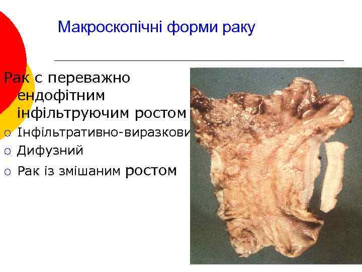 Макроскопічні форми раку Рак с переважно ендофітним інфільтруючим ростом ¡ Інфільтративно-виразковий Дифузний ¡ Рак