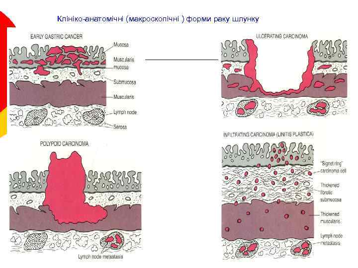 Клініко-анатомічні (макроскопічні ) форми раку шлунку 26 