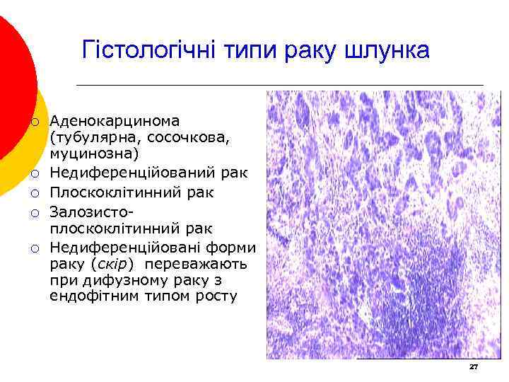 Гістологічні типи раку шлунка ¡ ¡ ¡ Аденокарцинома (тубулярна, сосочкова, муцинозна) Недиференційований рак Плоскоклітинний