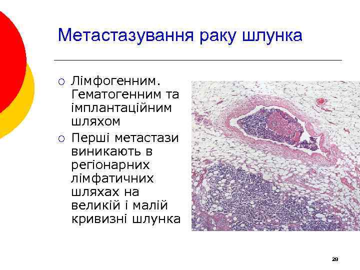 Метастазування раку шлунка ¡ ¡ Лімфогенним. Гематогенним та імплантаційним шляхом Перші метастази виникають в
