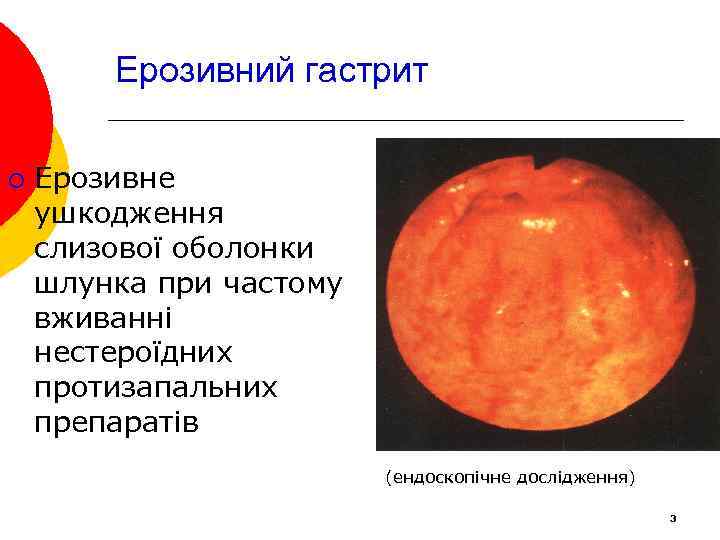 Ерозивний гастрит ¡ Ерозивне ушкодження слизової оболонки шлунка при частому вживанні нестероїдних протизапальних препаратів