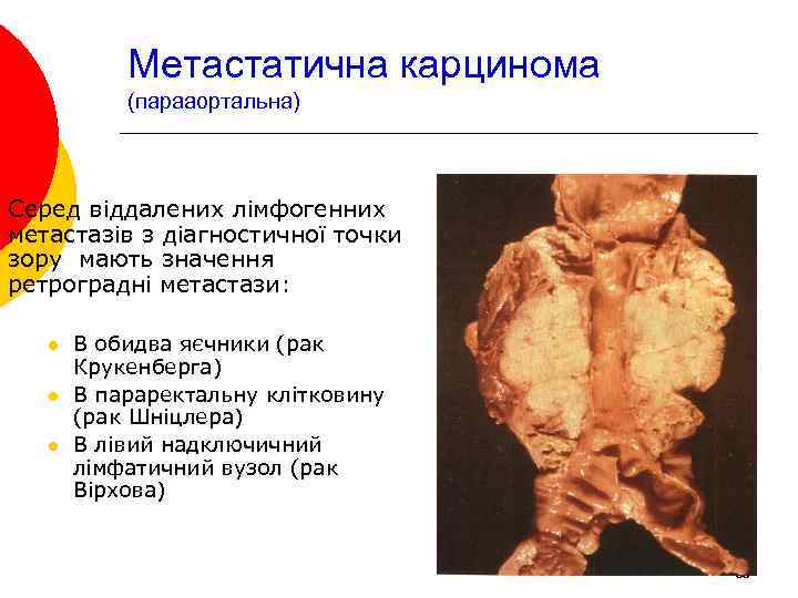 Метастатична карцинома (парааортальна) Серед віддалених лімфогенних метастазів з діагностичної точки зору мають значення ретроградні