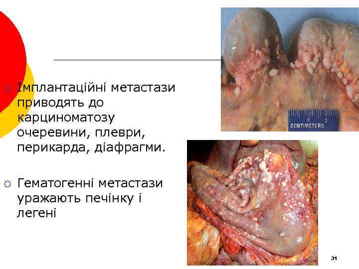 ¡ Імплантаційні метастази приводять до карциноматозу очеревини, плеври, перикарда, діафрагми. ¡ Гематогенні метастази уражають