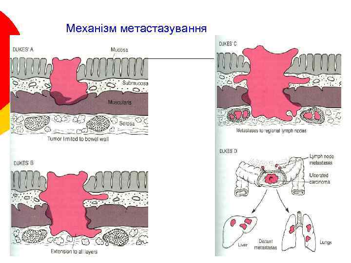 Механізм метастазування 32 