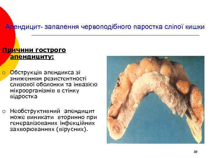 Апендицит- запалення червоподібного паростка сліпої кишки Причини гострого апендициту: ¡ Обструкція апендикса зі зниженням