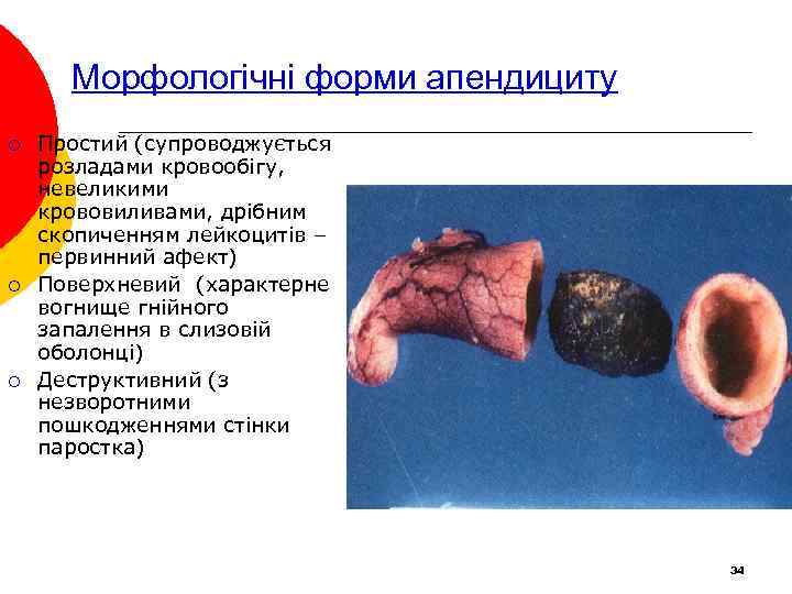 Морфологічні форми апендициту ¡ ¡ ¡ Простий (супроводжується розладами кровообігу, невеликими крововиливами, дрібним скопиченням