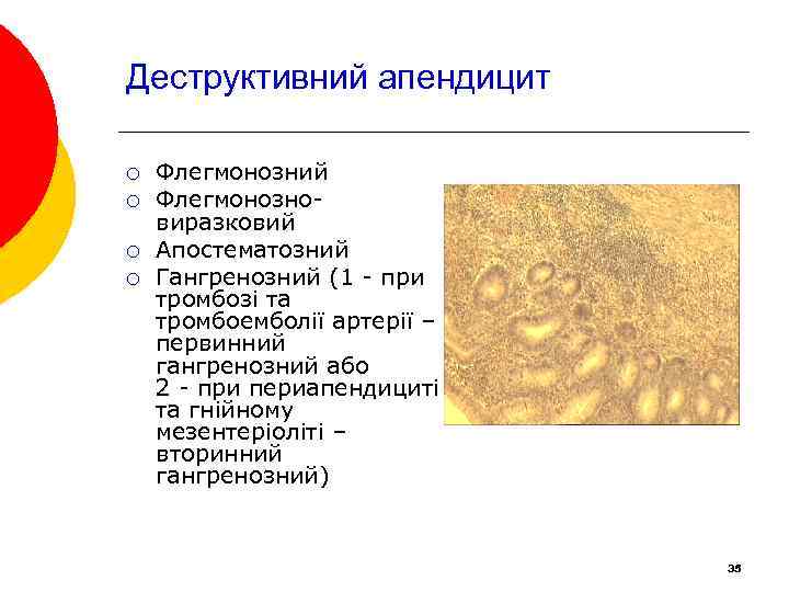 Деструктивний апендицит ¡ ¡ Флегмонозний Флегмонозновиразковий Апостематозний Гангренозний (1 - при тромбозі та тромбоемболії