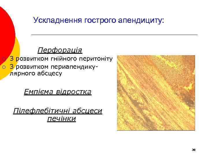 Ускладнення гострого апендициту: Перфорація ¡ ¡ З розвитком гнійного перитоніту З розвитком периапендикулярного абсцесу