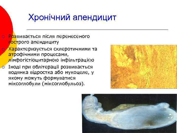 Хронічний апендицит ¡ ¡ ¡ Розвивається після перенесеного гострого апендициту Характеризується склеротичними та атрофічними