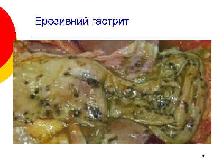 Ерозивний гастрит 4 