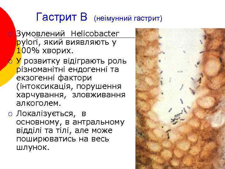 Гастрит В ¡ ¡ ¡ (неімунний гастрит) Зумовлений Helicobacter pylori, який виявляють у 100%