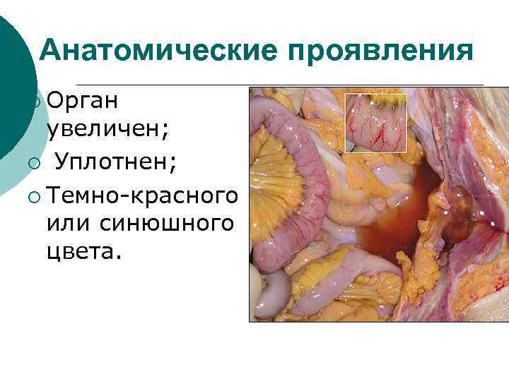 Анатомические проявления ¡ Орган увеличен; ¡ Уплотнен; ¡ Темно-красного или синюшного цвета. 