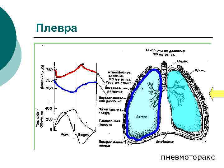 Плевра пневмоторакс 