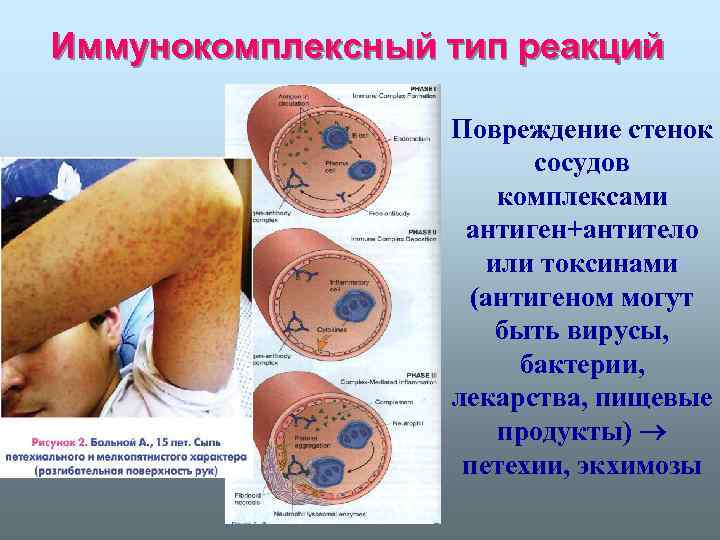 Иммунокомплексный тип реакций Повреждение стенок сосудов комплексами антиген+антитело или токсинами (антигеном могут быть вирусы,