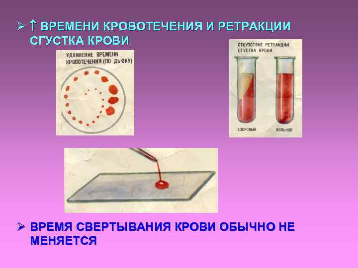 Ø ВРЕМЕНИ КРОВОТЕЧЕНИЯ И РЕТРАКЦИИ СГУСТКА КРОВИ Ø ВРЕМЯ СВЕРТЫВАНИЯ КРОВИ ОБЫЧНО НЕ МЕНЯЕТСЯ