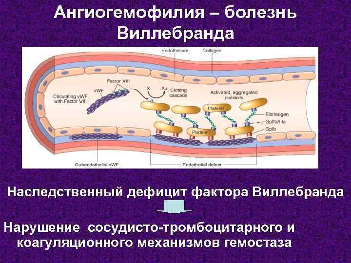 Ангиогемофилия – болезнь Виллебранда Наследственный дефицит фактора Виллебранда Нарушение сосудисто-тромбоцитарного и коагуляционного механизмов гемостаза