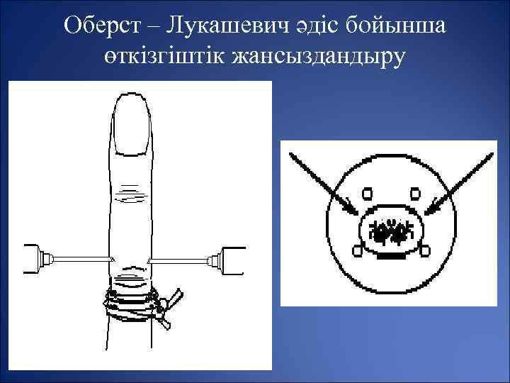 Схема проводниковой анестезии по оберсту лукашевичу