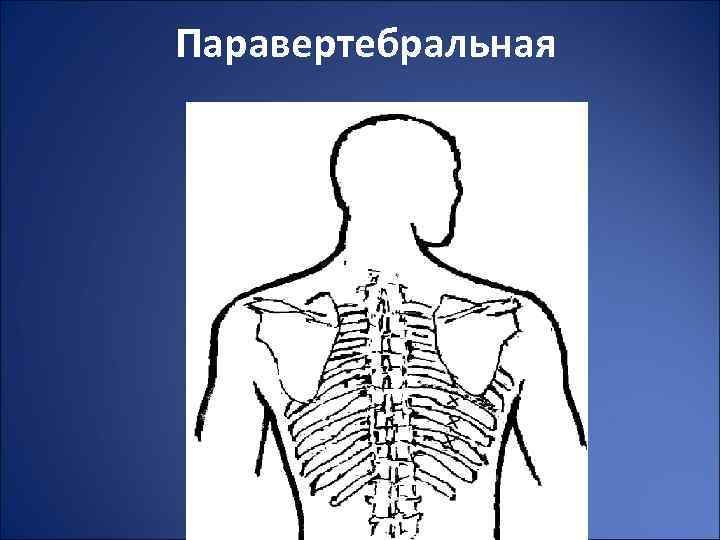 Паравертебральная 