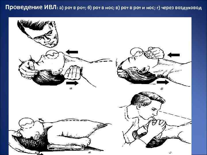 Проведение ИВЛ: а) рот в рот; б) рот в нос; в) рот в рот