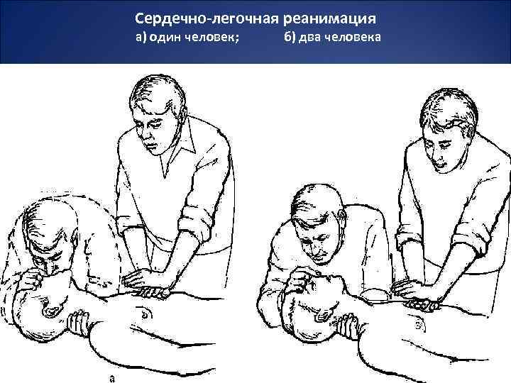 Сердечно-легочная реанимация а) один человек; б) два человека 