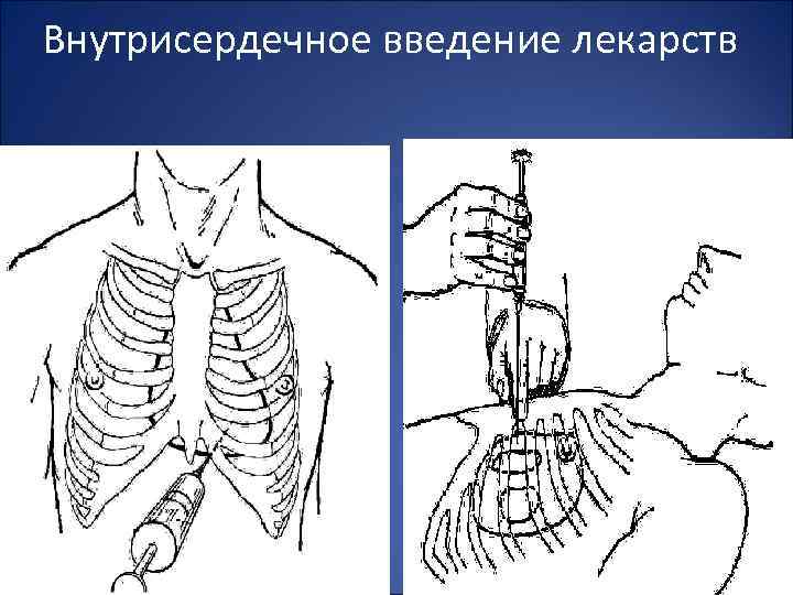 Внутрисердечное введение лекарств 