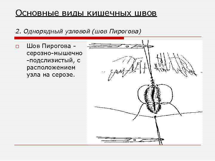 Основные виды кишечных швов 2. Однорядный узловой (шов Пирогова) o Шов Пирогова серозно-мышечно -подслизистый,