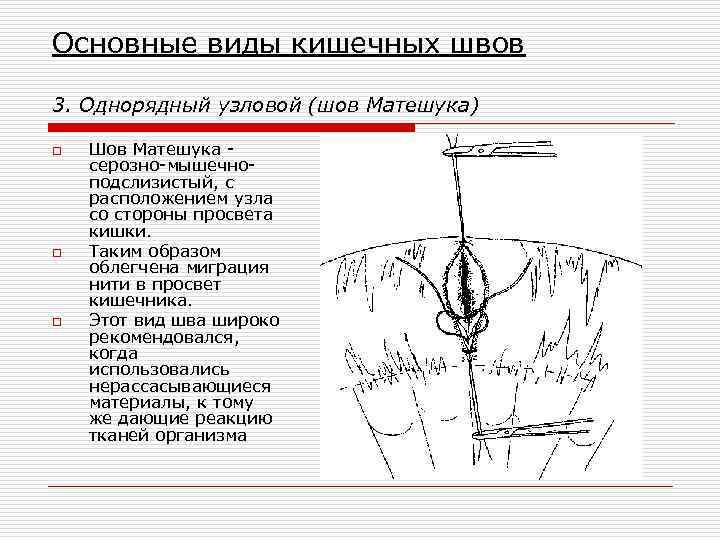 Основные виды кишечных швов 3. Однорядный узловой (шов Матешука) o o o Шов Матешука