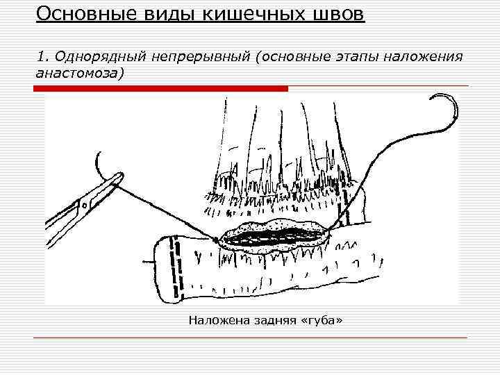 Основные виды кишечных швов 1. Однорядный непрерывный (основные этапы наложения анастомоза) Наложена задняя «губа»