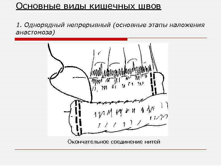 Основные виды кишечных швов 1. Однорядный непрерывный (основные этапы наложения анастомоза) Окончательное соединение нитей