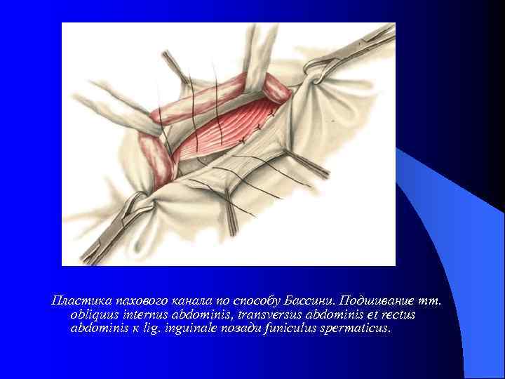 Пластика пахового канала по способу Бассини. Подшивание mm. obliquus internus abdominis, transversus abdominis et