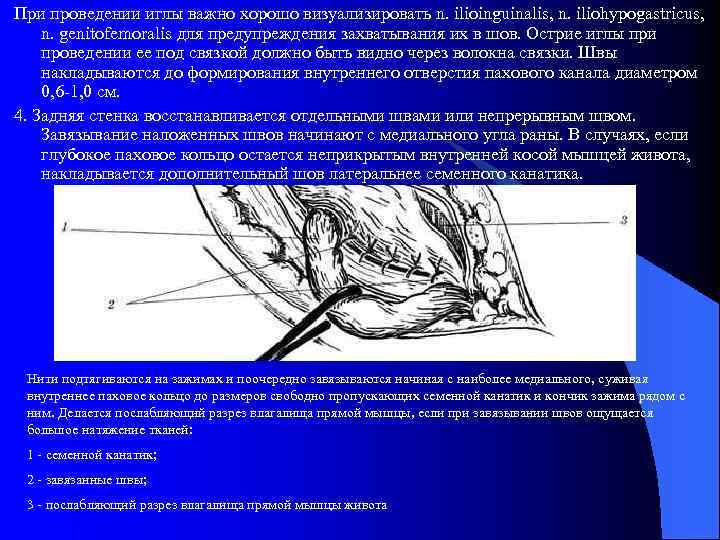 При проведении иглы важно хорошо визуализировать n. ilioinguinalis, n. iliohypogastricus, n. genitofemoralis для предупреждения