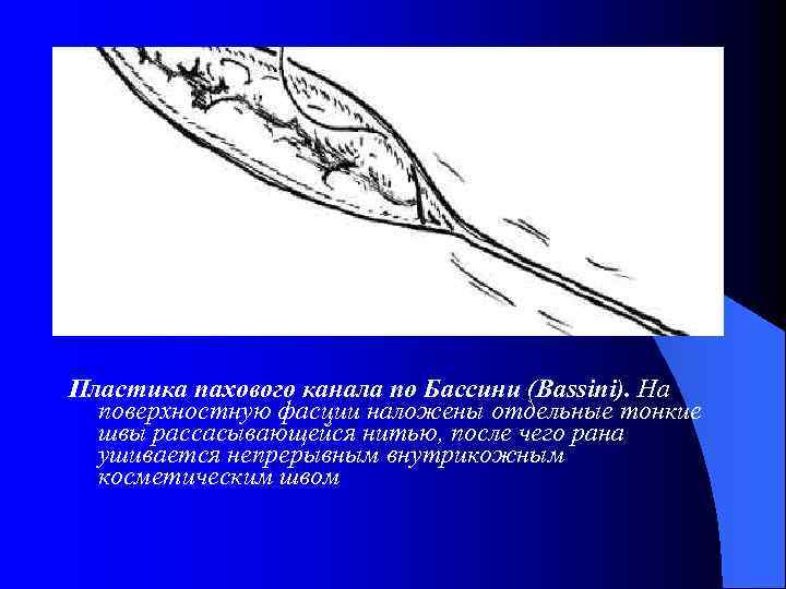 Пластика пахового канала по бассини