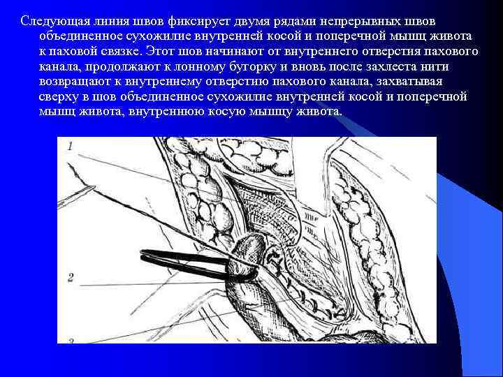 Пластика пахового канала по кимбаровскому