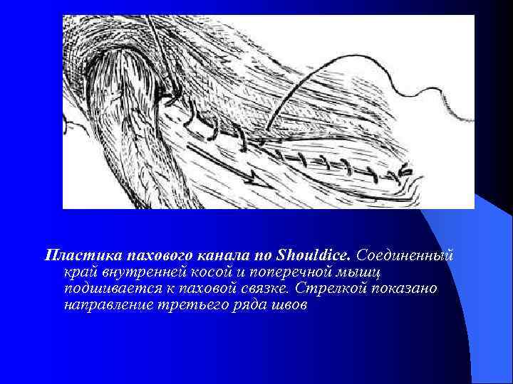 Пластика пахового канала по Shouldice. Соединенный край внутренней косой и поперечной мышц подшивается к