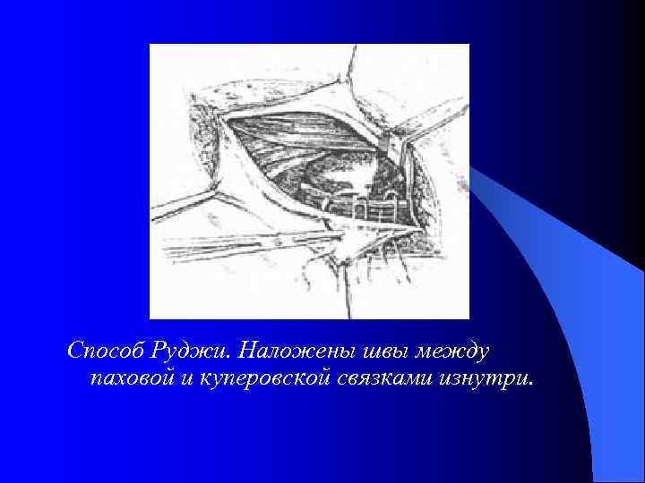 Способ Руджи. Наложены швы между паховой и куперовской связками изнутри. 