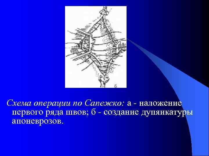 Пластика грыж по сапежко