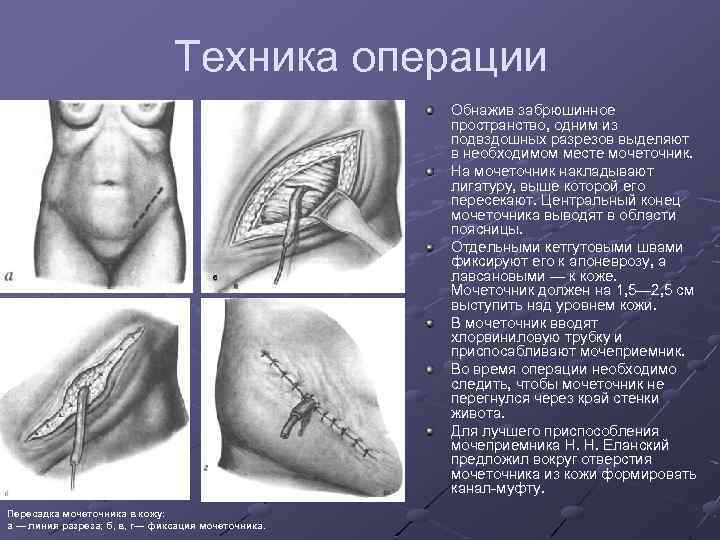 Как выглядит стенд в мочеточнике у женщин фото