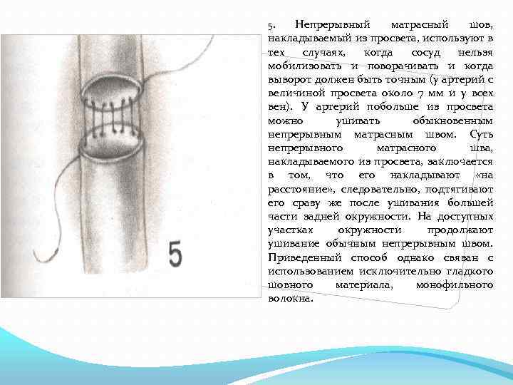 Непрерывный матрасный шов, накладываемый из просвета, используют в тех случаях, когда сосуд нельзя мобилизовать