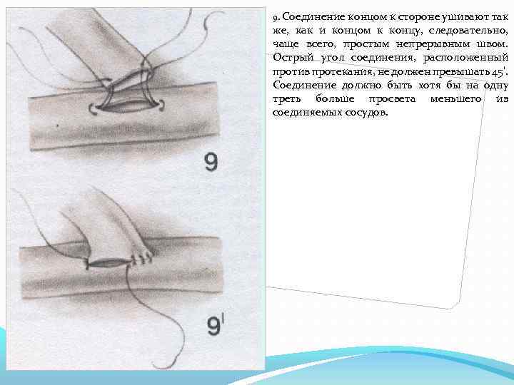 9. Соединение концом к стороне ушивают так же, как и концом к концу, следовательно,