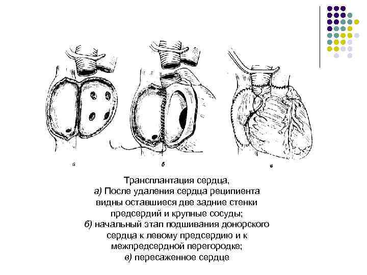 Трансплантация сердца, а) После удаления сердца реципиента видны оставшиеся две задние стенки предсердий и