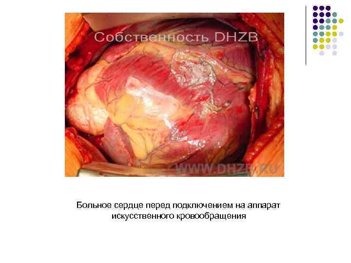 Больное сердце перед подключением на аппарат искусственного кровообращения 