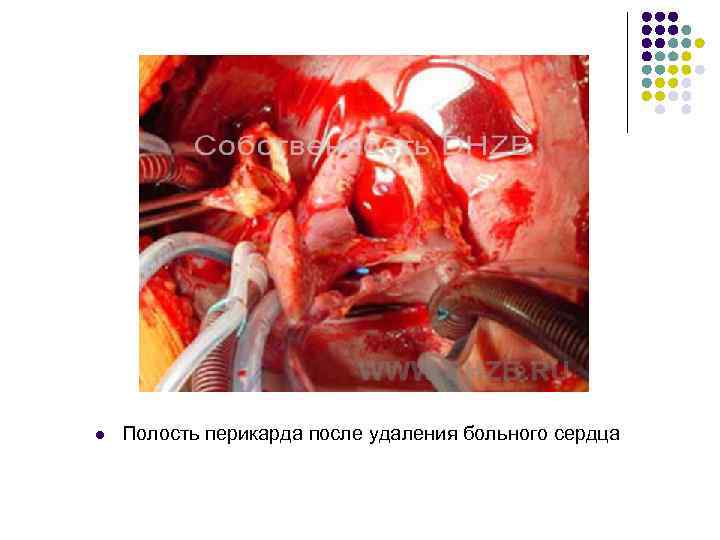 l Полость перикарда после удаления больного сердца 