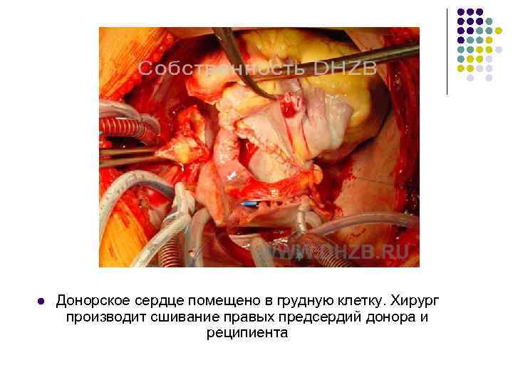 l Донорское сердце помещено в грудную клетку. Хирург производит сшивание правых предсердий донора и