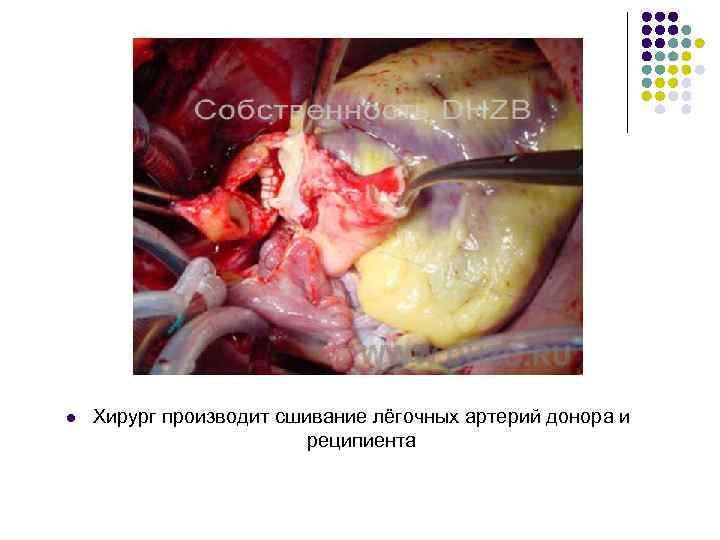 l Хирург производит сшивание лёгочных артерий донора и реципиента 