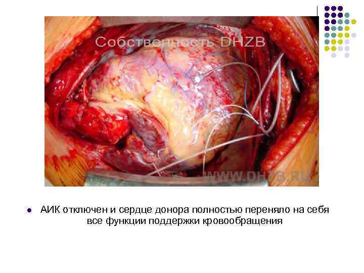 l АИК отключен и сердце донора полностью переняло на себя все функции поддержки кровообращения