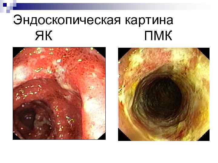 Эндоскопическая картина ЯК ПМК 
