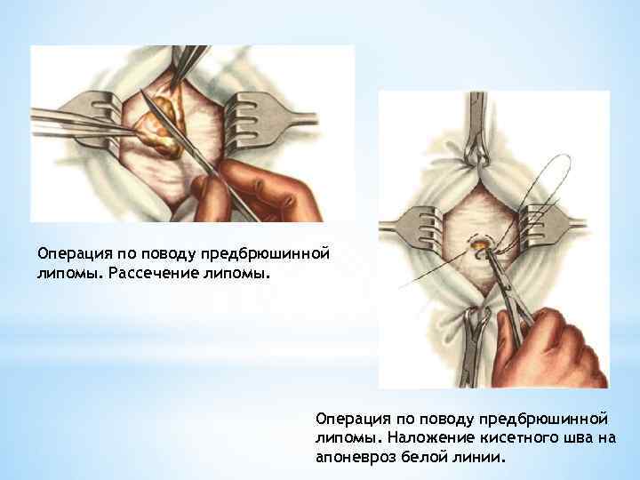 Операция по поводу предбрюшинной липомы. Рассечение липомы. Операция по поводу предбрюшинной липомы. Наложение кисетного