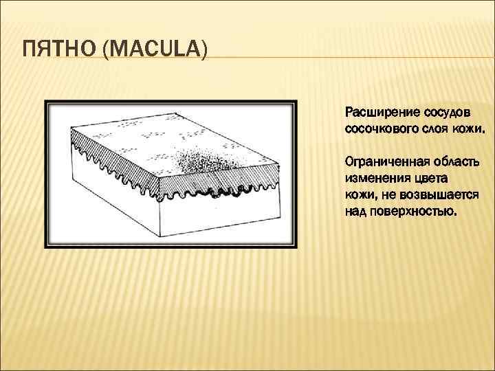 ПЯТНО (MACULA) Расширение сосудов сосочкового слоя кожи. Ограниченная область изменения цвета кожи, не возвышается