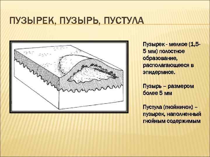 ПУЗЫРЕК, ПУЗЫРЬ, ПУСТУЛА Пузырек - мелкое (1, 55 мм) полостное образование, располагающееся в эпидермисе.